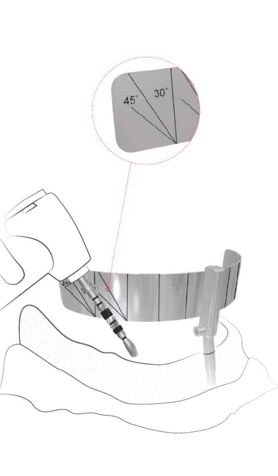 Несъемный зубной протез All-on-four несъемные зубные протезы